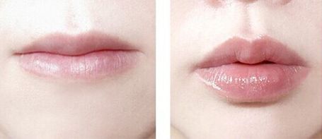 佛山做鼻子手術(shù)哪家醫(yī)院靠譜？