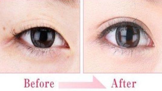 蘇州雙眼皮哪家做的好？專業(yè)攻略與醫(yī)師推薦