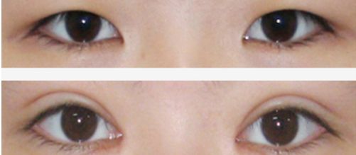 上海祛痘坑的醫(yī)院哪家好？讓你遠(yuǎn)離痘痘困擾的專業(yè)醫(yī)院有哪些？