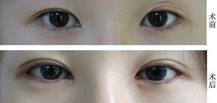 福州抽脂大腿哪家醫(yī)院好？挑選福州最靠譜的抽脂醫(yī)院有哪些？