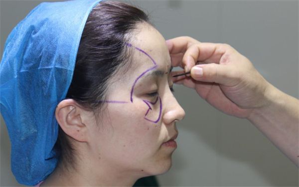 南寧哪家醫(yī)院痘印治療效果最佳？