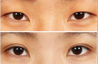 南寧去痘坑哪家醫(yī)院好？揭秘南寧市治療痘坑的頂尖專家團(tuán)隊！