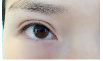 南昌祛痘哪家醫(yī)院口碑好，效果最佳？