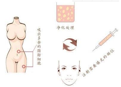 廣州燒傷疤痕治療哪家醫(yī)院效果好，選擇哪家醫(yī)院最靠譜？