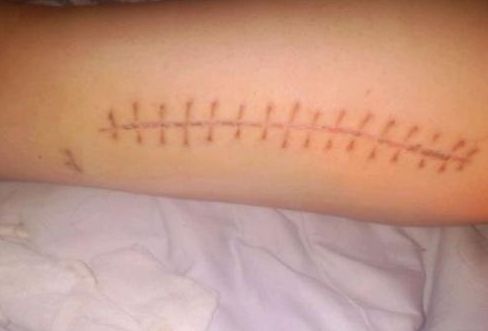 南寧祛除疤痕哪家醫(yī)院比較專業(yè)？