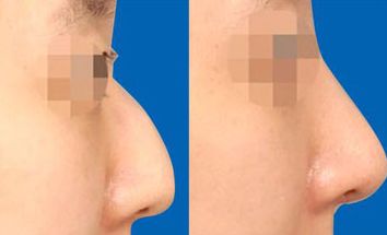 南京鼻綜合修復(fù)醫(yī)院哪家好？找準(zhǔn)南京鼻部整形中心，為你解答！