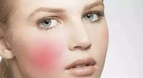 沈陽杏林醫(yī)生張瑩瑩治療雙眼皮修復效果如何？附真實網(wǎng)友高清修復前后對比圖