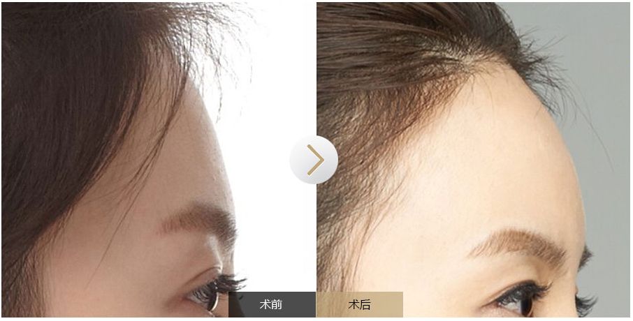 南寧點痣需求旺盛，哪家醫(yī)院是最受歡迎的？