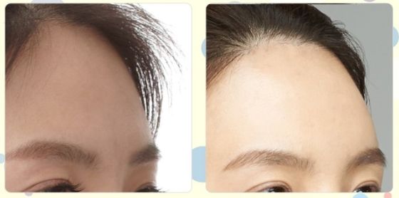 南京最好的祛痘醫(yī)院是哪家？揭秘南京治療痘痘首選醫(yī)院