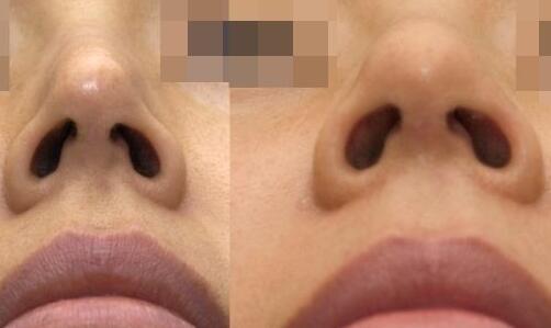 靳小雷雙眼皮修復(fù)手術(shù)的完美案例分享，期待您的見證