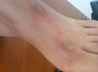 溫州哪家醫(yī)院做雙眼皮手術(shù)好？