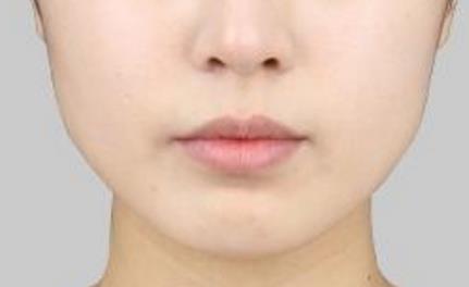 2023甘肅鼻背寬矯正術(shù)強(qiáng)榜前十的醫(yī)生(歷國(guó)媛、劉俊玲、陳志芳口碑出色)