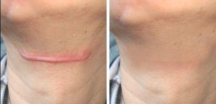 杭州市疤痕醫(yī)院哪家好？無(wú)痕祛疤，專(zhuān)業(yè)技術(shù)讓你恢復(fù)自信！