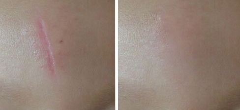 西安雙眼皮手術(shù)最佳推薦，哪家醫(yī)院技術(shù)好？