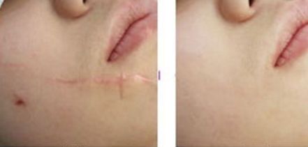 福州激光祛色斑哪家好？了解福州激光祛斑的優(yōu)秀機(jī)構(gòu)推薦！