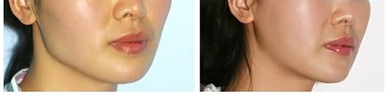 合肥假體隆胸哪家醫(yī)院好？術(shù)后效果如何？