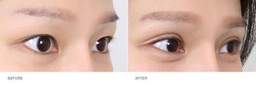 上海整容醫(yī)生推薦：讓您擁有完美鼻型，變身肋骨鼻！