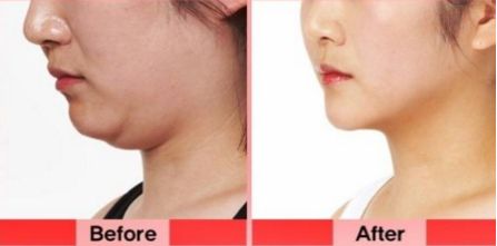 洛陽雙眼皮修復(fù)哪家好？挑選專業(yè)技術(shù)實力強的醫(yī)療機構(gòu)