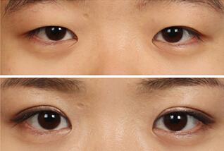 2023南京微創(chuàng)眼睛細(xì)紋手術(shù)醫(yī)生前10位排名(王軍成、江賀、郭鋒等都是強(qiáng)中強(qiáng))