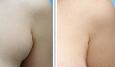 深圳北大何君君墊下巴案例分享，細(xì)節(jié)透露驚艷效果