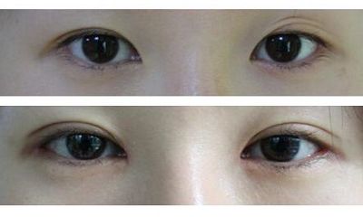 長(zhǎng)沙哪家醫(yī)院專業(yè)去痘印效果好，讓你的肌膚恢復(fù)光滑無(wú)瑕