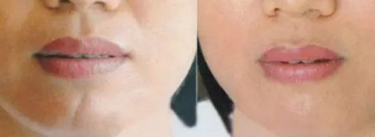 上海面部除疤效果最好的醫(yī)院有哪些？