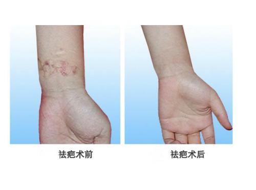 2023杭州臀部吸脂術(shù)前十強(qiáng)專家(金柱、李晨陽(yáng)、趙曉陽(yáng)實(shí)力盡顯一二！)