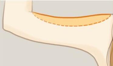 劉金超磨骨手術(shù)：專家點(diǎn)評(píng)+價(jià)格表解析，全面了解醫(yī)生技術(shù)及口碑