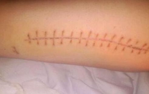 北京哪家醫(yī)院的隆胸假體效果好且價(jià)格合理