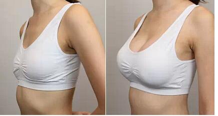 廣州脂肪隆胸醫(yī)生技術(shù)高超，手術(shù)效果自然倍受贊譽(yù)