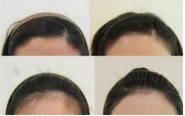 哈爾濱皮秒手術(shù)哪家醫(yī)院好？全面評測哈爾濱皮秒醫(yī)院排名