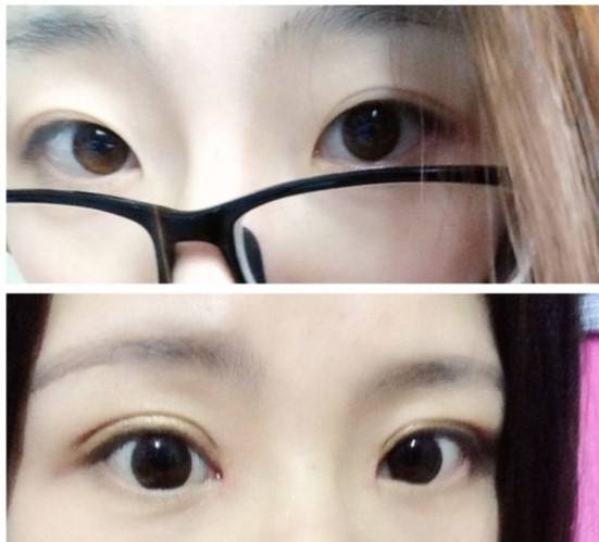 2023黃石小切口去頸部皺紋前十強(qiáng)專家排名(韓斌、余秋芬、陳杰深受當(dāng)?shù)厝耸肯矏?