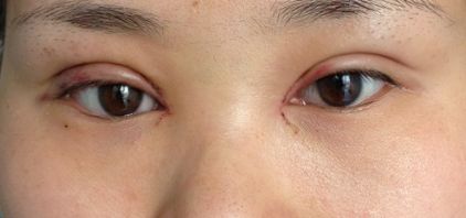 沈陽哪家醫(yī)院疤痕手術(shù)效果好？