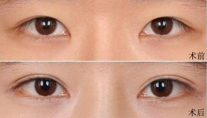 大連假體隆鼻哪家醫(yī)院好？打造完美鼻型，這家醫(yī)院是最佳選擇！