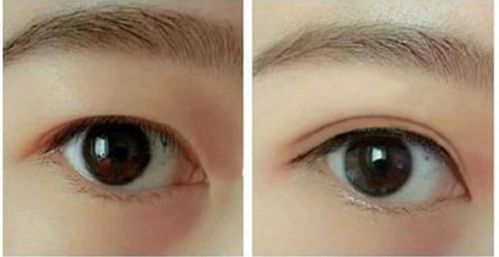 揭秘！哈爾濱哪家醫(yī)院的隆鼻手術(shù)效果最好推薦