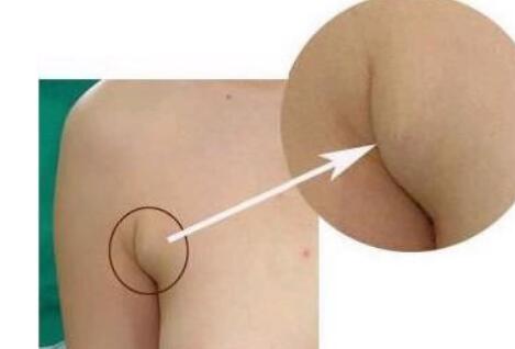 張誠教授為您的雙眼皮修復(fù)提供完美解決方案！成功案例分享，糾正雙眼皮失敗的救星~