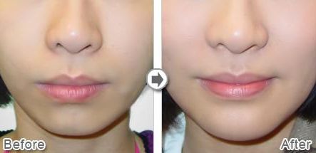 武漢熱瑪吉技術(shù)治療最好的醫(yī)院是哪家？