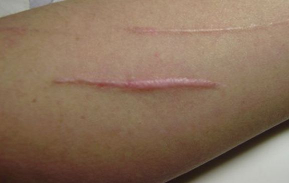 深圳哪家醫(yī)院的取膨體效果最好？