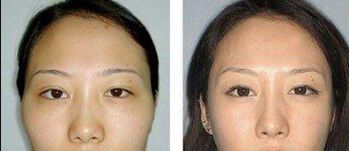 重慶去眼袋哪家醫(yī)院好？選擇靠譜的醫(yī)療機(jī)構(gòu)，功效更可靠！