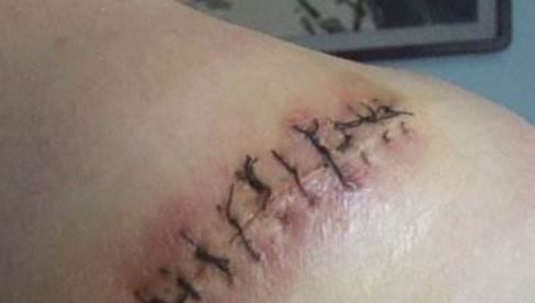 信陽哪家醫(yī)院祛痘效果好，專家推薦去哪家醫(yī)院治療痘痘？