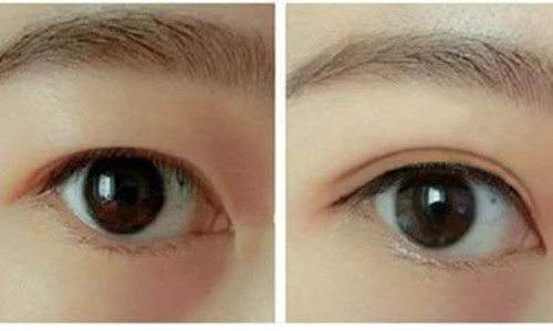 2023廈門抬頭紋微創(chuàng)提升口碑十強專家(賈虹、黃巖、張少軍收費價格不貴)