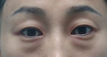 天津醫(yī)院去疤膏效果好的有哪些？