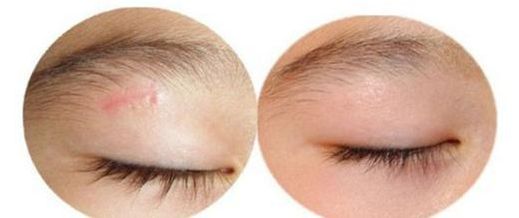 上海顴弓手術(shù)哪家醫(yī)院效果好，專家推薦