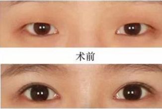 昆明哪家醫(yī)院做熱瑪吉好？挑選昆明熱瑪吉治療專業(yè)的醫(yī)院指南