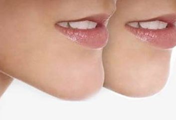 河南唇腭裂休復(fù)哪家好？專業(yè)醫(yī)院推薦及成功案例分享