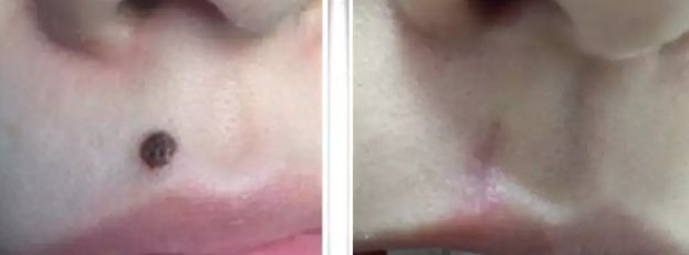 福州割眼袋醫(yī)院排行榜2023：哪家醫(yī)院割眼袋好？