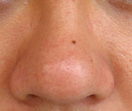 2023廣東熱瑪吉淡化眼部細(xì)紋醫(yī)生評(píng)價(jià)TOP10(程寧新、劉志剛、羅盛康有名收費(fèi)價(jià)格不貴)