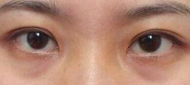 何照華下頜角手術(shù)的效果如何？明星們做了手術(shù)前后對(duì)比驚艷！