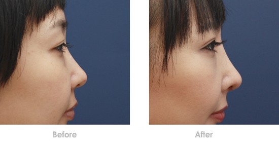 2023寧波激光去咖啡斑膨體隆鼻醫(yī)生前10強(qiáng)排名(鄔薇薇、高文彬、郭光燁經(jīng)驗豐富不？)