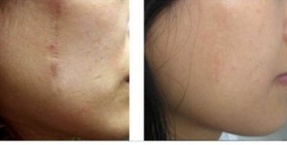 南京開雙眼皮哪家醫(yī)院好？幫你解析南京哪家醫(yī)院做開雙眼皮效果最好